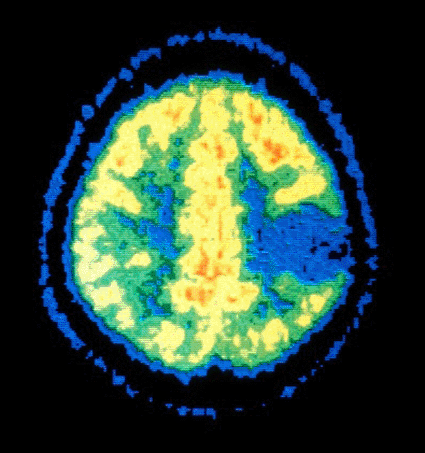 Image: Colored positron emission tomography (PET) of an axial section through the brain showing a benign astrocytoma (Photo courtesy of the National Cancer Institute).